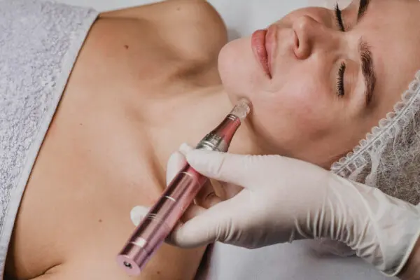 Microneedling