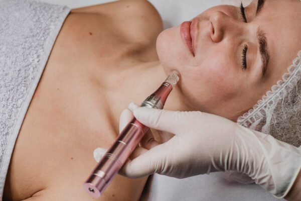 Microneedling